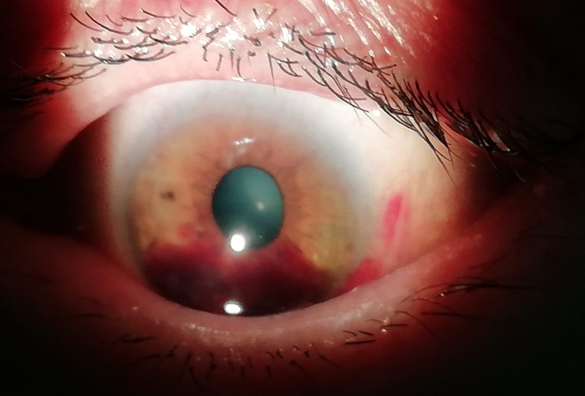 Нижегородские врачи впервые выполнили операцию по лечению расслоения роговицы глаза