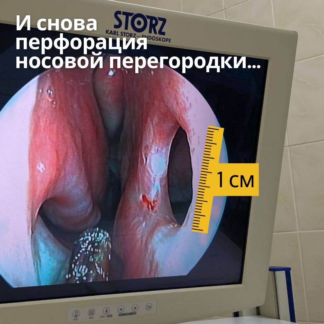 Нижегородские медики зашили сантиметровую дыру в носу пациентки