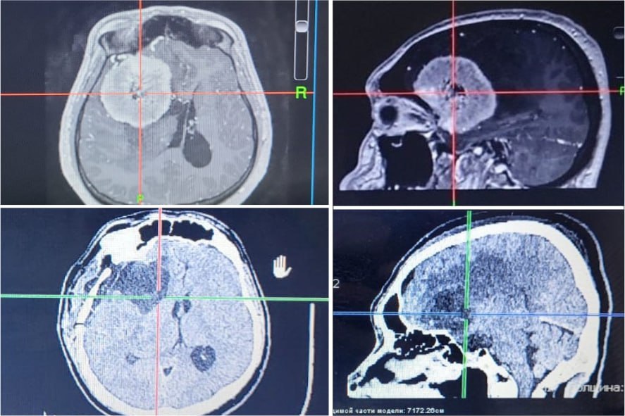Врачи удалили у мужчины огромную опухоль головного мозга