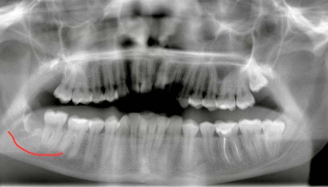 Нижегородские врачи пересадили пациенту его собственный зуб