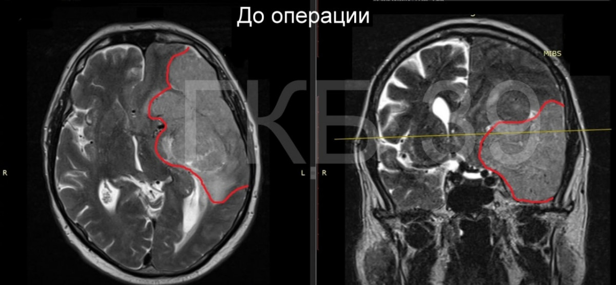 Нейрохирурги ГКБ №39 удалили нижегородцу гигантскую опухоль головного мозга